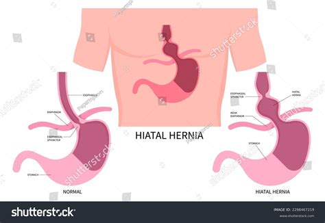 Nissen Fundoplication Surgery Dallas Tx Gerd Treatment