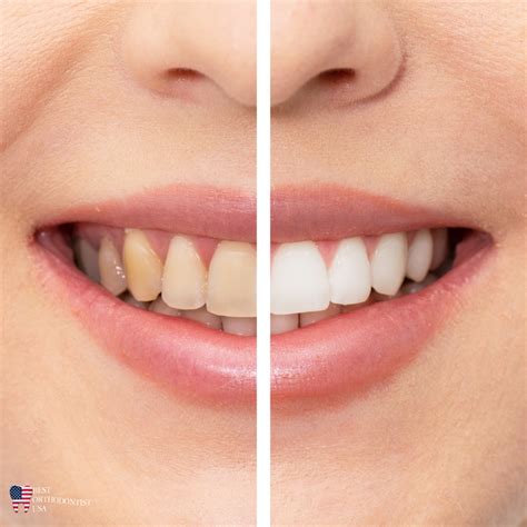 Image result for Discolored Tooth