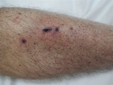 What Causes Black Spots On Lower Legs at Ava Soul blog
