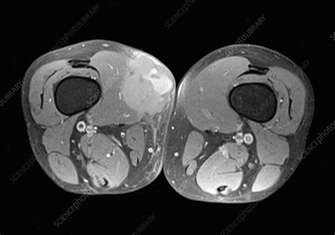 Sarcoma, MRI scan - Stock Image - C056/4360 - Science Photo Library
