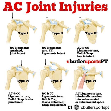 Acromioclavicular (AC joint) injuries are shoulder injuries commonly… | Alan Nash