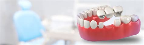 Dental Crowns and Dental Bridges Treatment