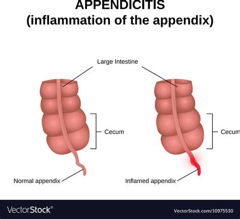 Image result for Appendix Inflammation