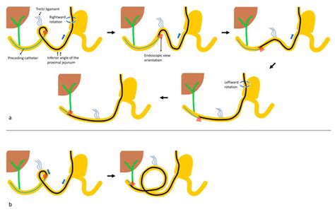 Outcomes and Loop Pattern Analysis of a Road-Map Technique for ERCP ...