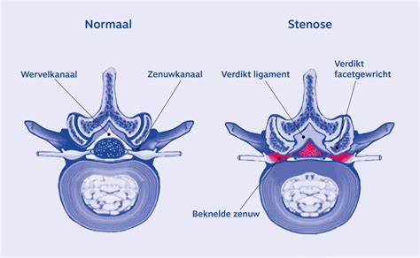 Simptomi spinalne stenoze – Hercegovina.in