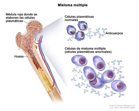 Definición de mieloma - Diccionario de cáncer del NCI - NCI