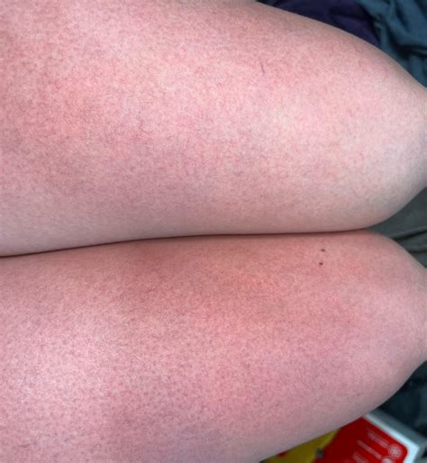 My sunburn is turning purple : r/medical_advice