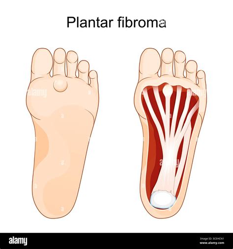 Plantar fascial fibromatosis below the 2nd toe. Ledderhose's disease. Morbus Ledderhose. Cross ...
