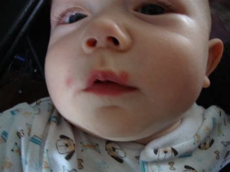 what are these sores around my baby's mouth? (pic) | BabyCenter
