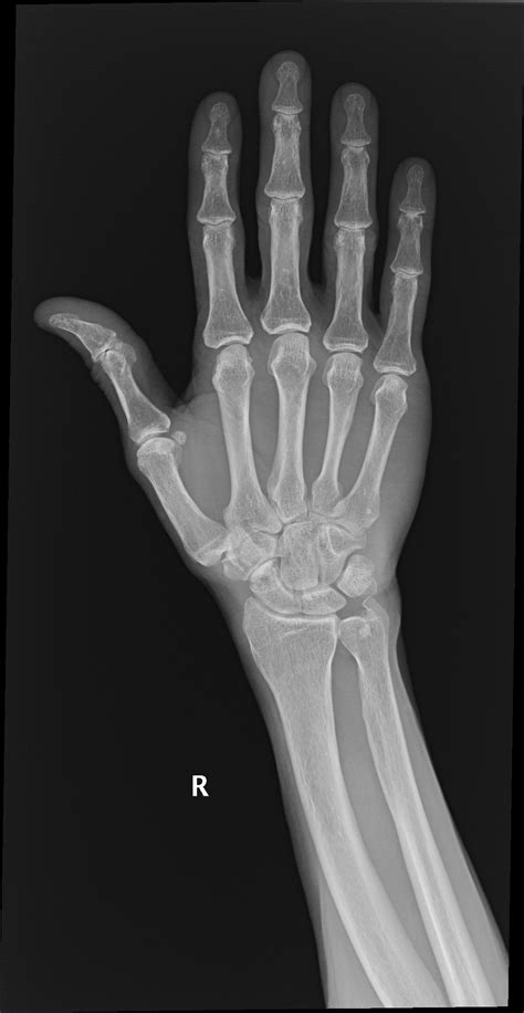 Fracture Of Triquetral Bone at Corinne Marx blog