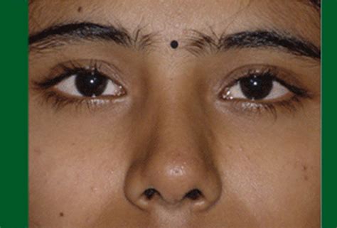 Sinus & Nose - Chennai India : Hospital for nose and sinuses - Dr. P ...