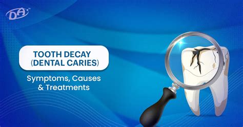 Tooth Decay (Dental Caries): Symptoms, Causes & Treatments – Dental Avenue