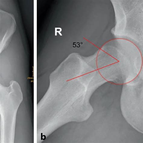 Femoroacetabuläres Impingement-Syndrom bei Jugendlichen - Orthopädie ...