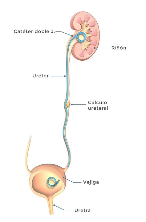 Todo sobre el catéter doble J - Devicare