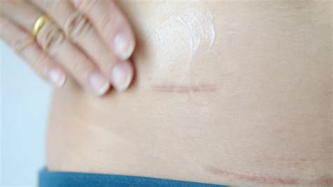 Using cream to care for scars after appendix surgery 32326490 Stock Video at Vecteezy
