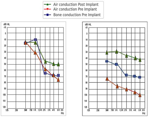 Middle Ear Active Implant Indications, Comparative Audiometric Results ...