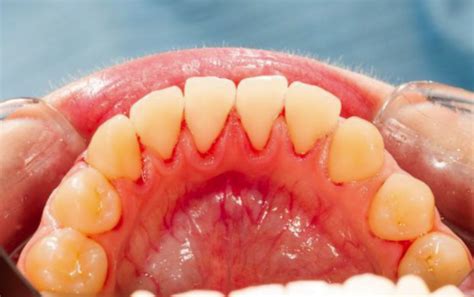 有效改善牙龈出血的5个技巧，你都知道吗？-为口腔医疗行业免费提供专业的微营销、医患医技交流、诊所管理、定制下单等一站式服务开放平台