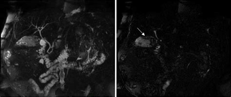 Image result for MRCP Biliary Tree