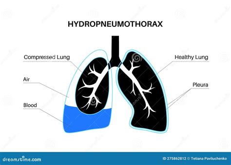 Hydropneumothorax Medical Poster Vector Illustration | CartoonDealer ...