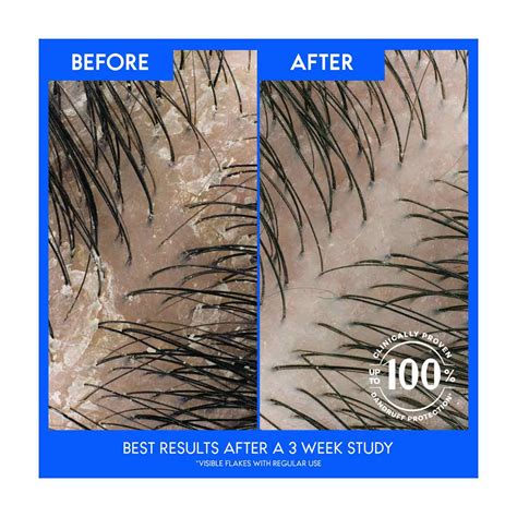 Buy Head and Shoulders 2 in 1 Dandruff Shampoo and Conditioner, Anti ...
