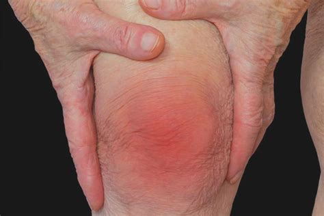 Knee Replacement Surgery in Chennai | Knee Replacement Surgeon in Chennai