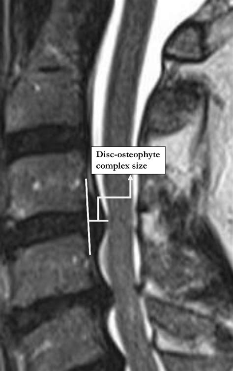 Illustration of disc-osteophyte complex size measurement. | Download ...