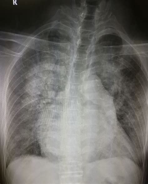 两肺纹理增多,左上肺野见纤维条索及斑点状高密度影,边界尚清,是肺结核么 内科
