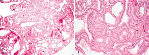 Epithelial Neoplasms of the Small Intestine - Clinical Tree