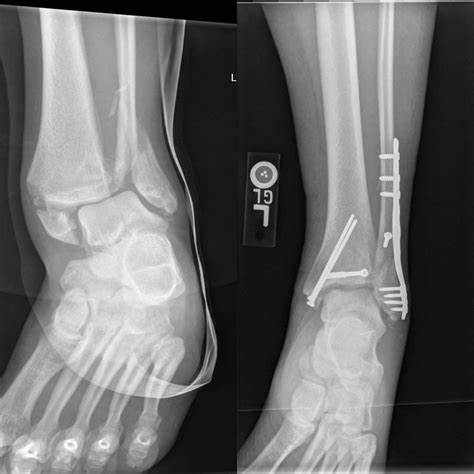 ANKLE FRACTURE BEFORE AND AFTER - Buyxraysonline