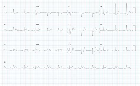 12 Lead ECG Practice Exercise - SkillStat