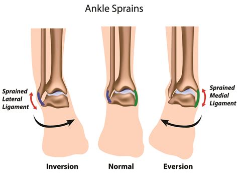 Ankle Sprain Grades 1
