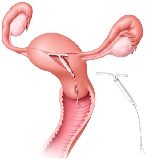 IUD contraceptive device, types, insertion, removal, risks & side effects