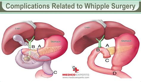 What is Whipple Procedure: A Comprehensive Overview