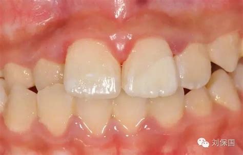 断牙再接术：救活你的牙齿 刘保国-牙医刘保国的博客-KQ88口腔博客