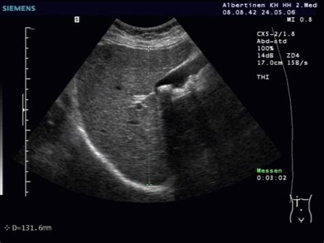 Normal Liver Ultrasound