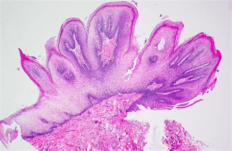 Pathology Outlines - WHO classification-oral cavity & oropharynx