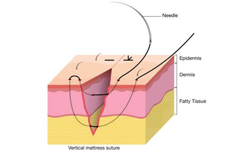 How to Remove Mattress Sutures | Top Surgical Suture Factory