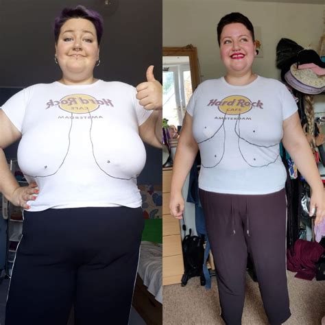 Three and a half Weeks post Breast Reduction | by Marlene Rössler | Medium