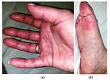A Case of Autoimmune Small Fiber Neuropathy as Possible Post COVID Sequelae
