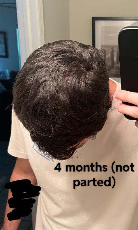 Topical minoxidil and not using shampoo : r/tressless