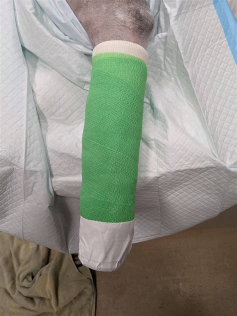Modified Robert-Jones Bandage – Brian's Bandages