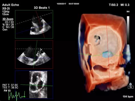 EPIQ CVxi Cardiac Ultrasound