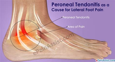Lateral Foot Pain or Pain on the Outer Side of the Foot!