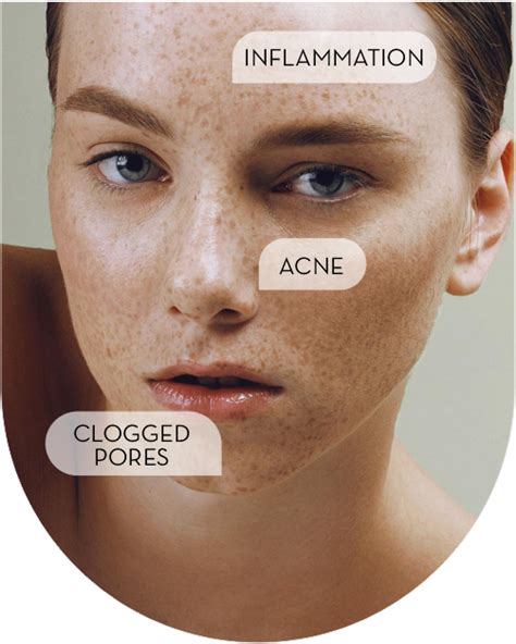 Breakup With Breakouts – Slova Cosmetics