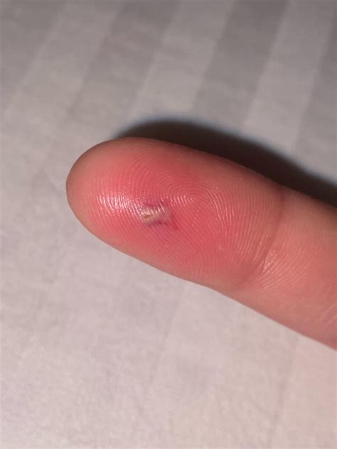 Image result for Infected Splinter Removal