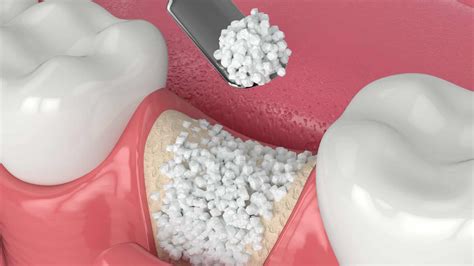 Bone Graft Pre-Operative Instructions | Atlas Dental Toronto