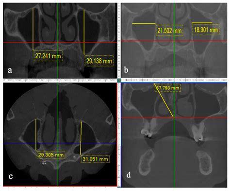 Volume Of Maxillary Sinus