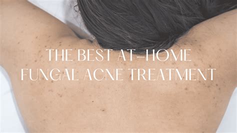 Best Fungal Acne Treatment At Home: The Ultimate Guide - Hello Mia Wilson