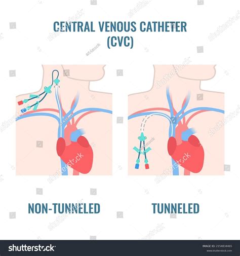 Non Tunneled Central Venous Catheter