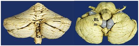 Cerebellar Tonsils